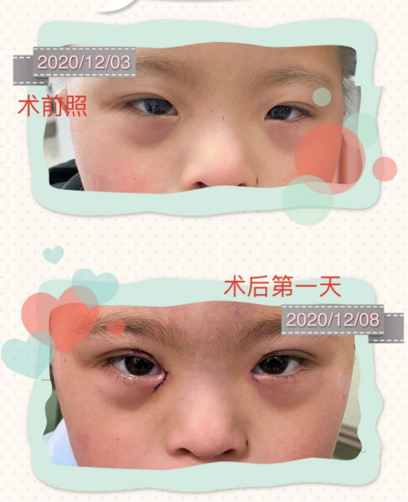 小眼裂,眼距宽,内眦赘皮,上睑内翻倒睫……5岁的宝宝是一名唐氏综合征