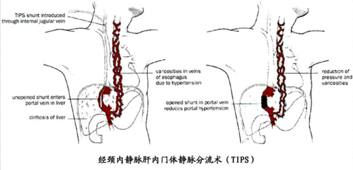 tips手术步骤的图片图片